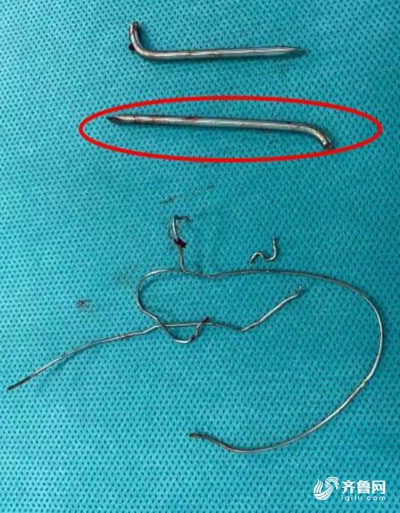 6.5cm钢针横卧体内 齐鲁医院完成高危异物取出术