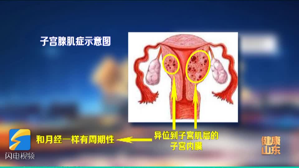 子宫腺肌症示意图图片