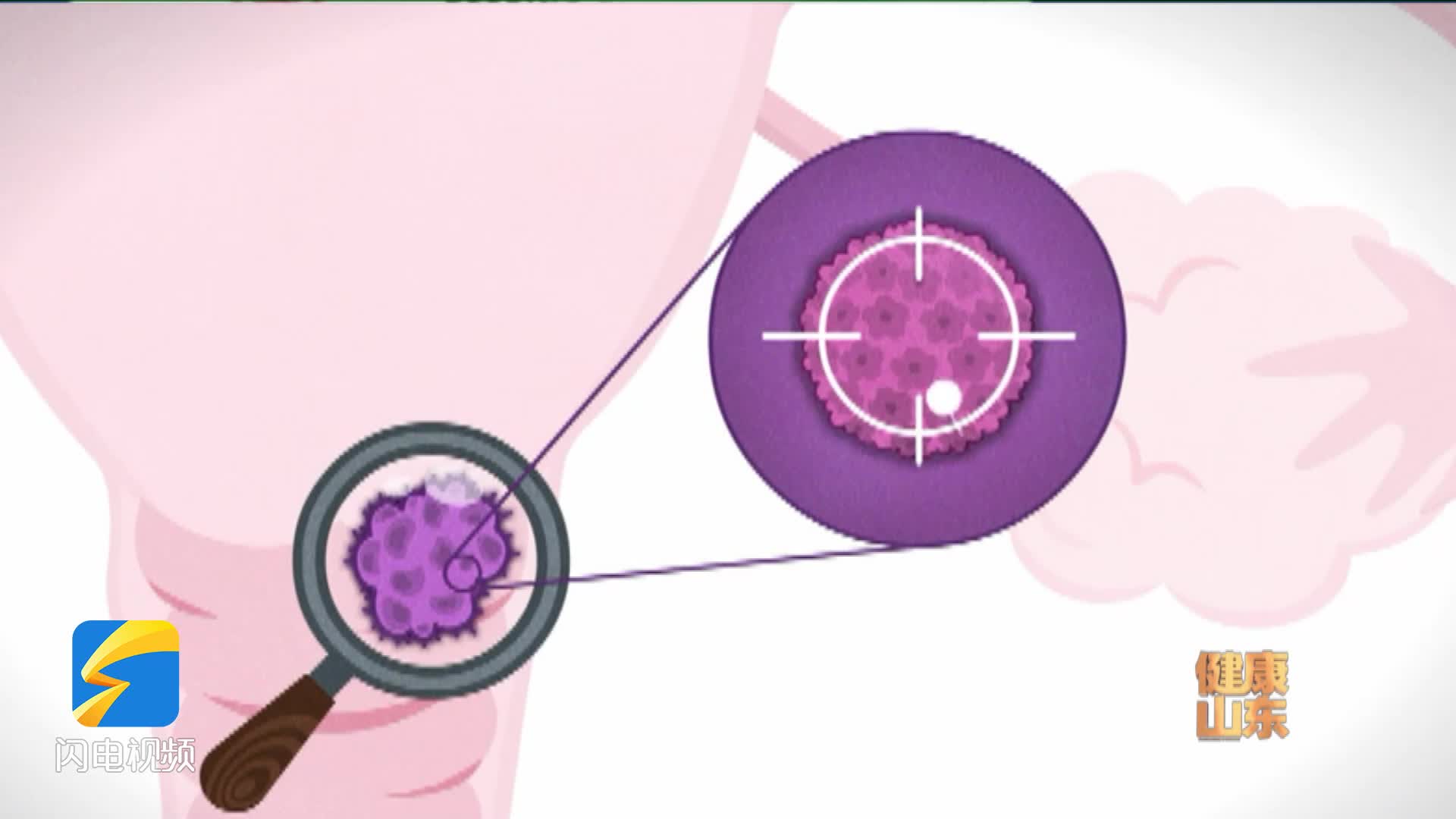 宫颈癌筛查，TCT和HPV怎么选？