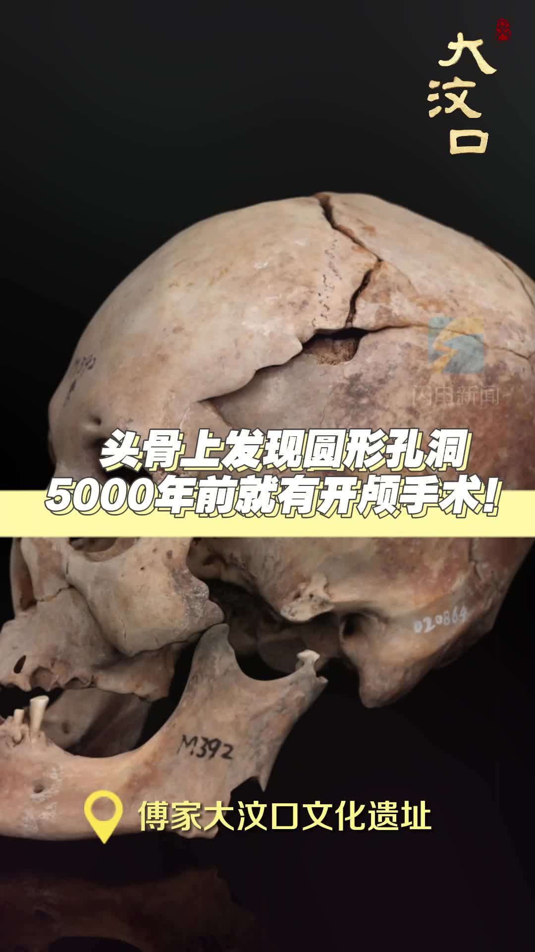 头骨上发现圆形孔洞 5000年前就有开颅手术！