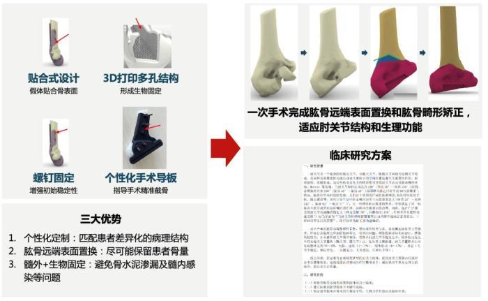 中国自主研发新型表面置换假体  填补空白、造福肘关节损伤者