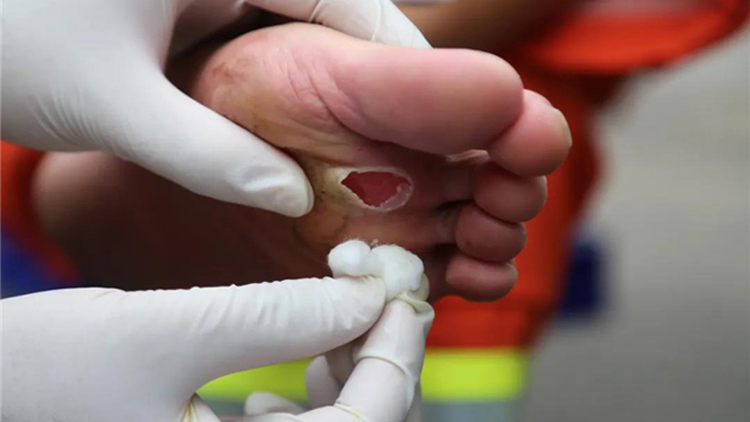 心疼支援河南的东营消防员双脚泡皱发白脚底磨出血泡