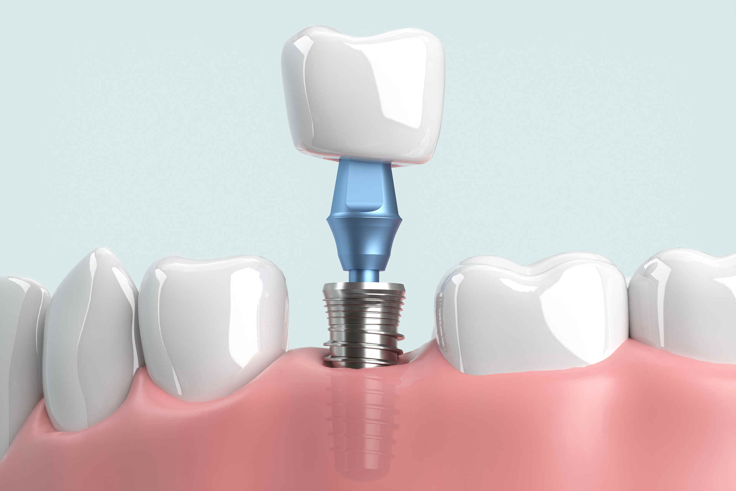 种植牙集采开标 一颗牙的整体费用有望降低50%左右