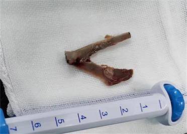 情况危急！V形鸡叉骨卡在食管，威海市中心医院多学科协作成功取骨