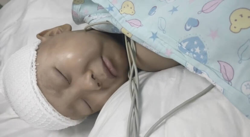 闪电公益｜5岁患癌男孩接受头部肿瘤切除手术 仍需筹措第二次手术费用20余万元