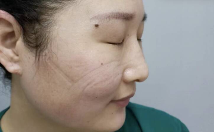 山东援沪医疗队员的脸上爬满了口罩压痕