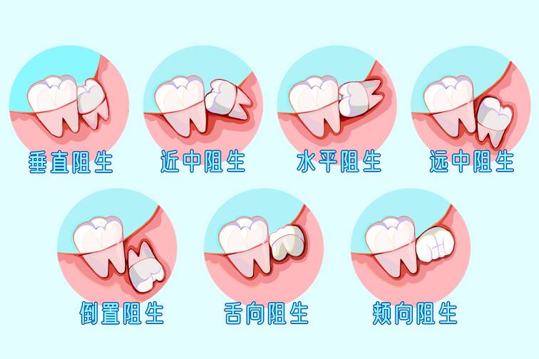 长了智齿一定要拔吗智齿有用吗