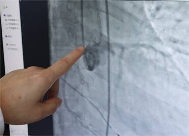 为重症心脏瓣膜病患者重启心“门” ！威海市中心医院成功开展第五例经导管主动脉瓣置换术