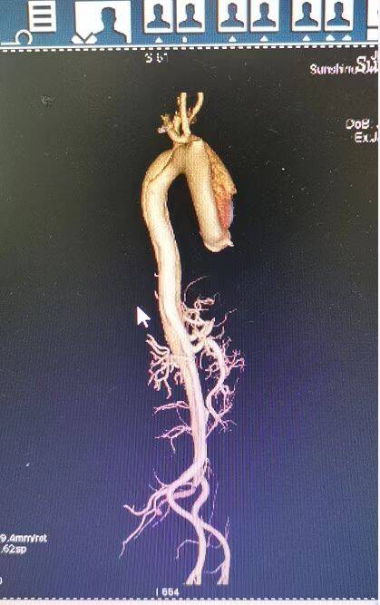 陽光融和醫院心臟大血管外科又成功救治一名複雜性a型主動脈夾層患者