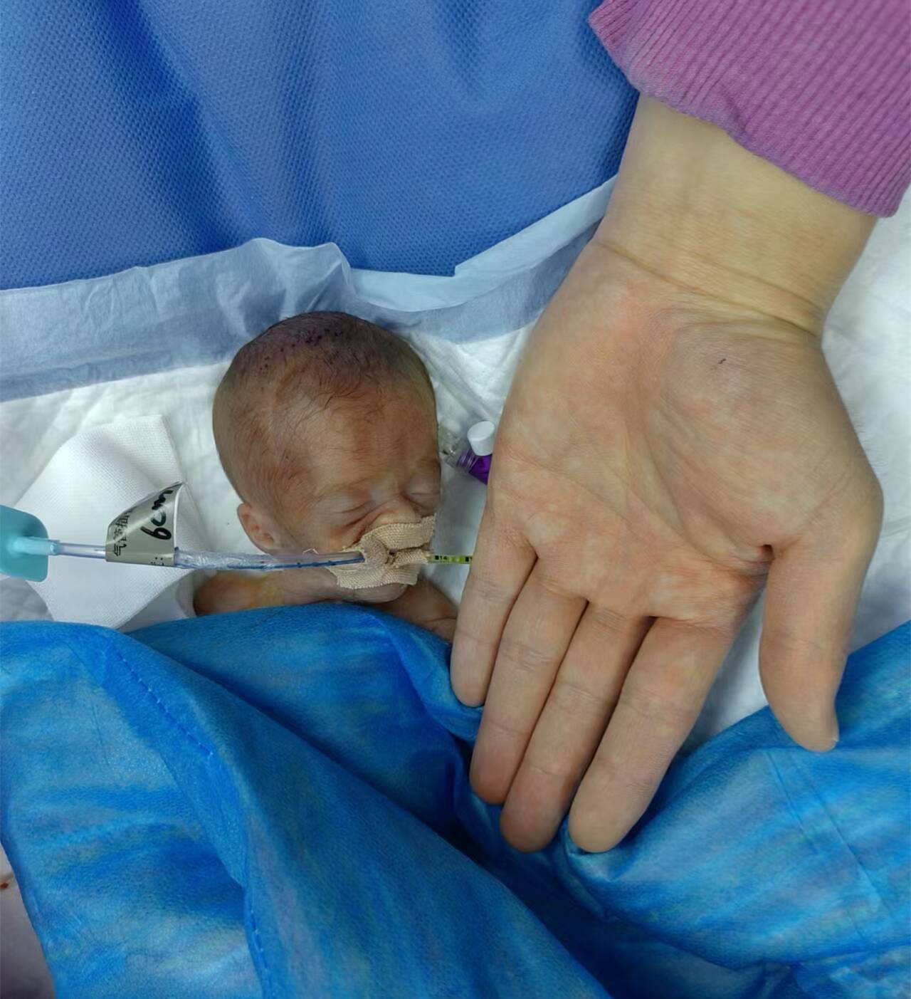 山东省妇幼保健院麻醉科成功护航580克超低体重早产儿剖腹探查术