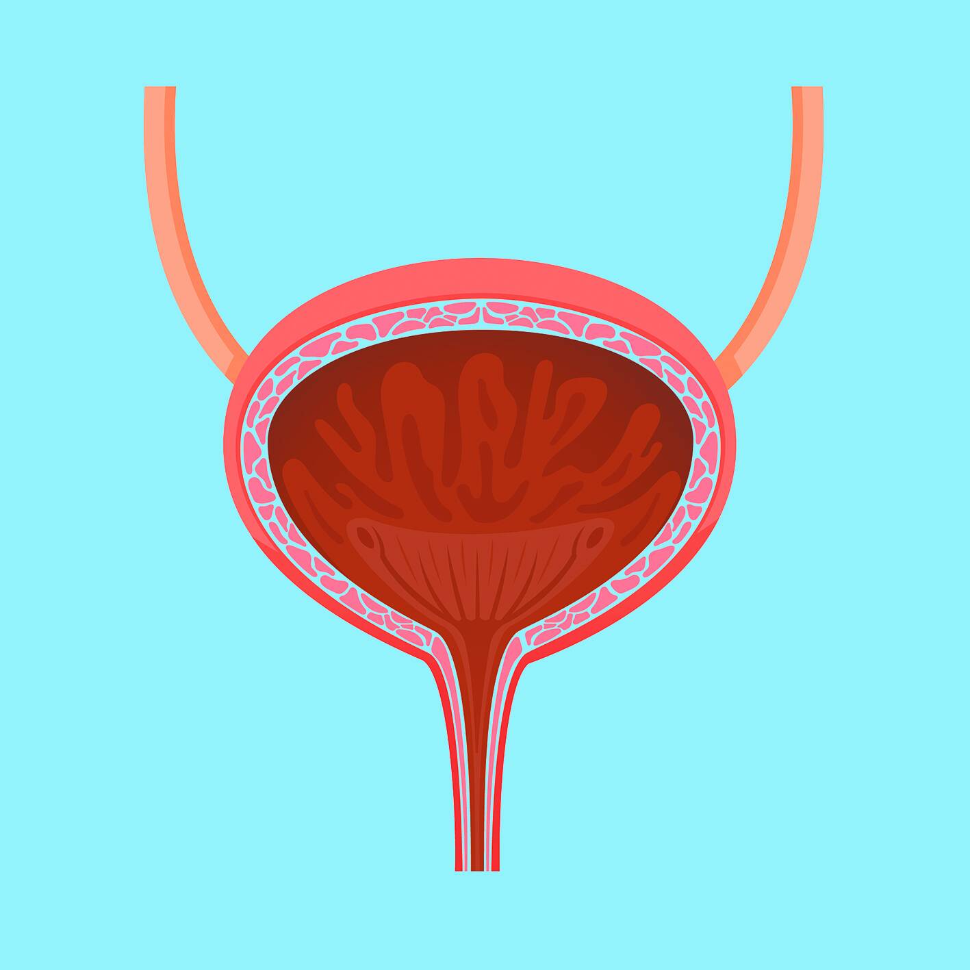 尿急、尿频、尿出血 可能是膀胱肿瘤在作怪