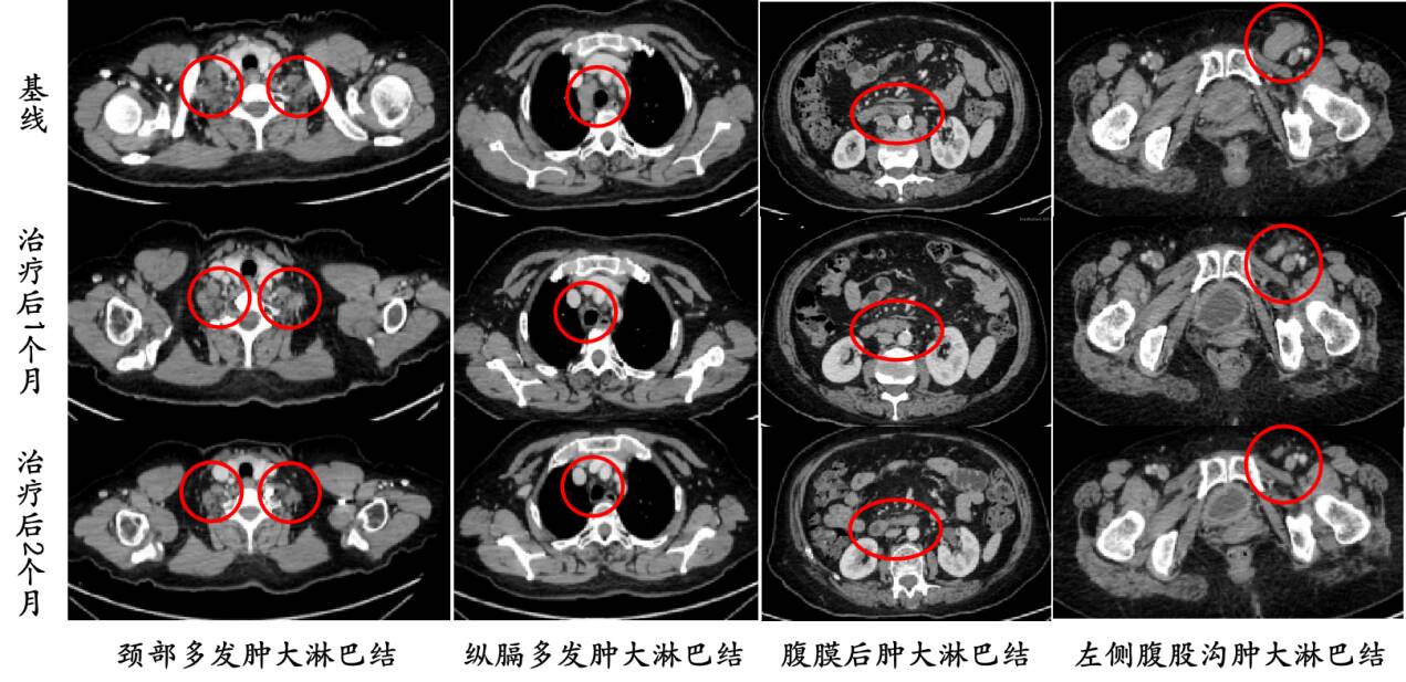 cart細胞治療為瀰漫大b淋巴瘤患者帶來生命的希望山東省第二人民醫院