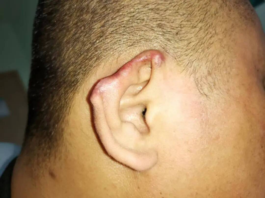 遇到这些情况不得不做耳整形手术了