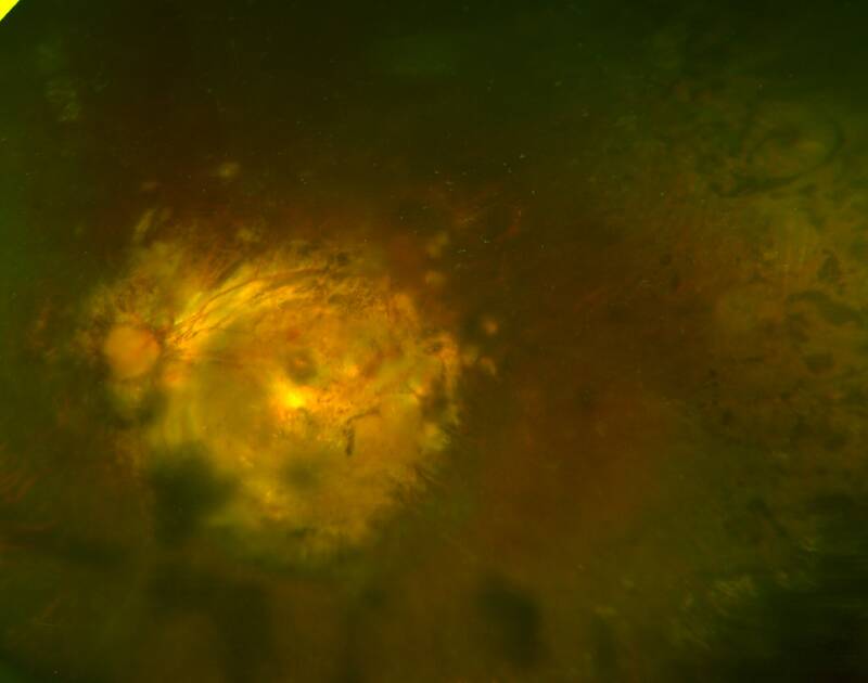 高度近视可能诱发这些眼底病,您了解多少?