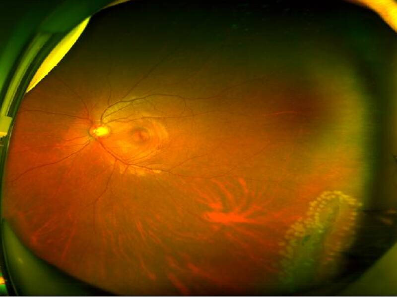 高度近视可能诱发这些眼底病,您了解多少?