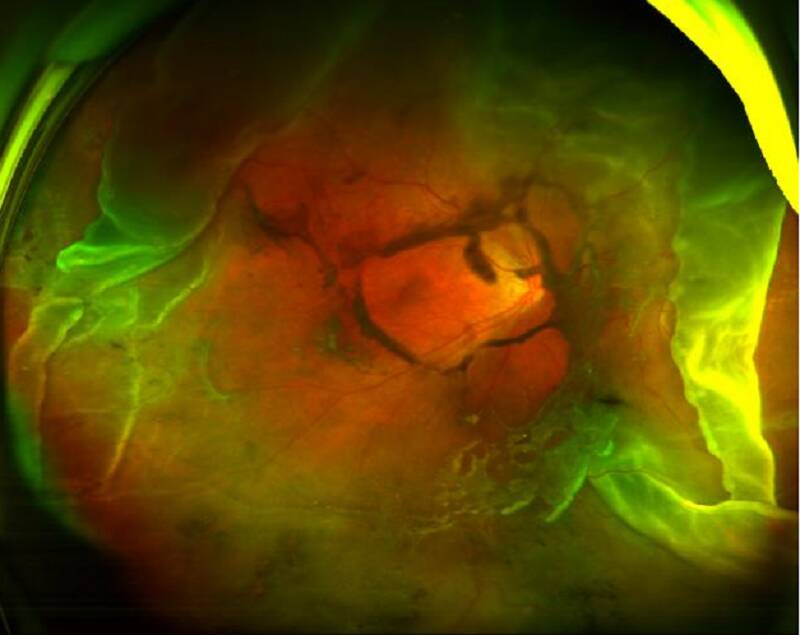 高度近视可能诱发这些眼底病,您了解多少?