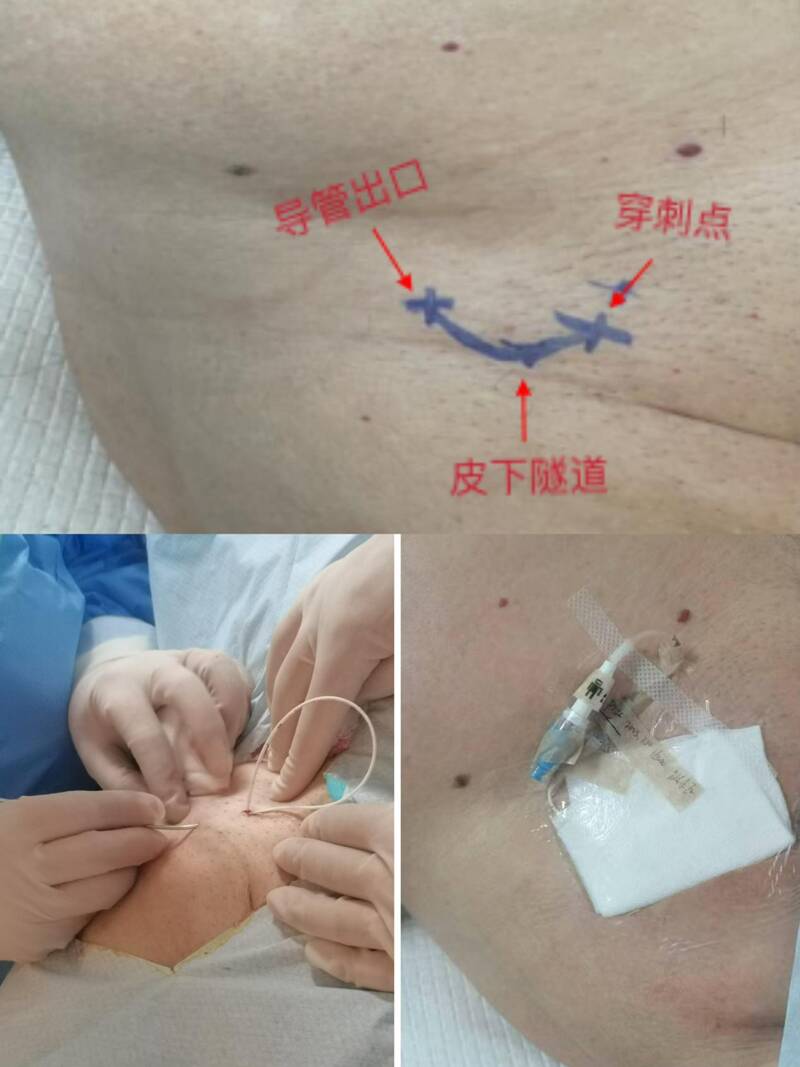生命通道再升级——济南市人民医院成功完成一例下肢隧道式PICC置入术
