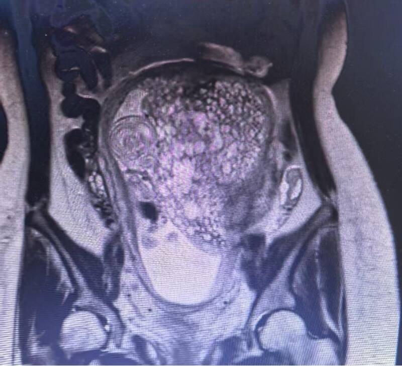 精准救治，化险为夷——济南市人民医院多学科协作成功救治罕见高危孕妇